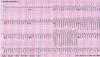 Photo for Ventricular Tachycardia-Global API Manufacturers, Marketed and Phase III Drugs Landscape, 2017