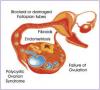 Photo for Women Infertility-Global API Manufacturers, Marketed and Phase III Drugs Landscape, 2017