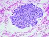 Photo for Medullary Thyroid Cancer-Global API Manufacturers, Marketed and Phase III Drugs Landscape, 2017