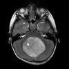 Photo for Medulloblastoma-Global API Manufacturers, Marketed and Phase III Drugs Landscape, 2017