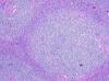 Photo for Mantle Cell Lymphoma-Global API Manufacturers, Marketed and Phase III Drugs Landscape, 2017