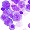 Photo for Megaloblastic Anemia-Global API Manufacturers, Marketed and Phase III Drugs Landscape, 2017
