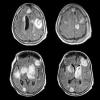 Photo for Metastatic Brain Tumor-Global API Manufacturers, Marketed and Phase III Drugs Landscape, 2017