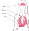 Photo for Metastatic Breast Cancer-Global API Manufacturers, Marketed and Phase III Drugs Landscape, 2017
