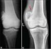 Photo for Osteosarcoma-Global API Manufacturers, Marketed and Phase III Drugs Landscape, 2017