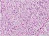 Photo for Pancreatic Endocrine Tumor-Global API Manufacturers, Marketed and Phase III Drugs Landscape, 2017
