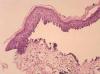 Photo for Pemphigus Vulgaris-Global API Manufacturers, Marketed and Phase III Drugs Landscape, 2017