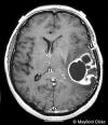 Photo for Malignant Glioma-Global API Manufacturers, Marketed and Phase III Drugs Landscape, 2017