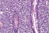 Photo for Peripheral T-Cell Lymphomas (PTCL)-Global API Manufacturers, Marketed and Phase III Drugs Landscape, 2017