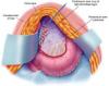 Photo for Peritoneal Tumor-Global API Manufacturers, Marketed and Phase III Drugs Landscape, 2017