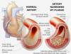 Photo for Peripheral Arterial Disease (PAD)/ Peripheral Vascular Disease (PVD)-Global API Manufacturers, Marketed and Phase III Drugs Landscape, 2017