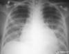 Photo for Pneumocystis Carinii Pneumonia-Global API Manufacturers, Marketed and Phase III Drugs Landscape, 2017