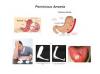 Photo for Pernicious Anemia-Global API Manufacturers, Marketed and Phase III Drugs Landscape, 2017