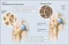 Photo for Post Menopausal Osteoporosis-Global API Manufacturers, Marketed and Phase III Drugs Landscape, 2017