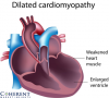 Photo for Dilated Cardiomyopathy Market – Global Industry Insights, Trends, and Opportunity Analysis, 2017 – 2025
