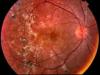 Photo for Posterior Uveitis-Global API Manufacturers, Marketed and Phase III Drugs Landscape, 2017
