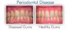 Photo for Periodontal Disease-Global API Manufacturers, Marketed and Phase III Drugs Landscape, 2017