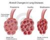 Photo for Pulmonary Edema-Global API Manufacturers, Marketed and Phase III Drugs Landscape, 2017
