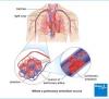 Photo for Pulmonary Embolism-Global API Manufacturers, Marketed and Phase III Drugs Landscape, 2017