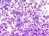 Photo for Polycythemia Vera-Global API Manufacturers, Marketed and Phase III Drugs Landscape, 2017