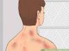 Photo for Radiation Toxicity (Radiation Sickness, Acute Radiation Syndrome)-Global API Manufacturers, Marketed and Phase III Drugs Landscape, 2017