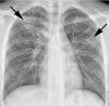 Photo for Pulmonary Tuberculosis-Global API Manufacturers, Marketed and Phase III Drugs Landscape, 2017