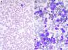 Photo for Refractory Anemia-Global API Manufacturers, Marketed and Phase III Drugs Landscape, 2017