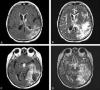 Photo for Recurrent Glioblastoma Multiforme (GBM)-Global API Manufacturers, Marketed and Phase III Drugs Landscape, 2017