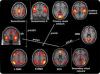 Photo for Relapsing Remitting Multiple Sclerosis (RRMS)-Global API Manufacturers, Marketed and Phase III Drugs Landscape, 2017