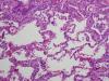 Photo for Respiratory Hypersensitivity-Global API Manufacturers, Marketed and Phase III Drugs Landscape, 2017