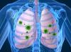 Photo for Respiratory Syncytial Virus (RSV) Infections-Global API Manufacturers, Marketed and Phase III Drugs Landscape, 2017