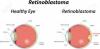 Photo for Retinoblastoma-Global API Manufacturers, Marketed and Phase III Drugs Landscape, 2017