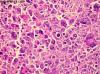 Photo for Rhabdomyosarcoma-Global API Manufacturers, Marketed and Phase III Drugs Landscape, 2017