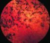 Photo for Retinitis Pigmentosa (Retinitis)-Global API Manufacturers, Marketed and Phase III Drugs Landscape, 2017