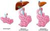 Photo for Short Bowel Syndrome-Global API Manufacturers, Marketed and Phase III Drugs Landscape, 2017