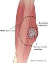 Photo for Soft Tissue Sarcoma-Global API Manufacturers, Marketed and Phase III Drugs Landscape, 2017