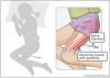 Photo for Spasticity-Global API Manufacturers, Marketed and Phase III Drugs Landscape, 2017
