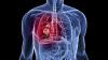 Photo for Small-Cell Lung Cancer-Global API Manufacturers, Marketed and Phase III Drugs Landscape, 2017