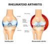 Photo for Systemic Juvenile Idiopathic Arthritis (SJIA)-Global API Manufacturers, Marketed and Phase III Drugs Landscape, 2017