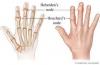Photo for Systemic Juvenile Rheumatoid Arthritis-Global API Manufacturers, Marketed and Phase III Drugs Landscape, 2017