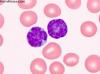 Photo for T-Cell Leukemia-Global API Manufacturers, Marketed and Phase III Drugs Landscape, 2017