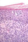 Photo for T-Cell Lymphomas-Global API Manufacturers, Marketed and Phase III Drugs Landscape, 2017