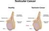 Photo for Testicular Cancer-Global API Manufacturers, Marketed and Phase III Drugs Landscape, 2017