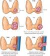 Photo for Thyroid Cancer-Global API Manufacturers, Marketed and Phase III Drugs Landscape, 2017