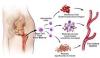 Photo for Thrombocythaemia Myelofibrosis-Global API Manufacturers, Marketed and Phase III Drugs Landscape, 2017