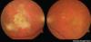 Photo for Wet (Neovascular / Exudative) Macular Degeneration-Global API Manufacturers, Marketed and Phase III Drugs Landscape, 2017