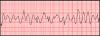 Photo for Ventricular Fibrillation-Global API Manufacturers, Marketed and Phase III Drugs Landscape, 2017
