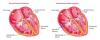 Photo for Wolff-Parkinson-White Syndrome-Global API Manufacturers, Marketed and Phase III Drugs Landscape, 2017