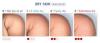 Photo for Xerosis (Dry Skin)-Global API Manufacturers, Marketed and Phase III Drugs Landscape, 2017