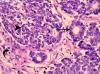 Photo for Wilms’ Tumor (Nephroblastoma)-Global API Manufacturers, Marketed and Phase III Drugs Landscape, 2017
